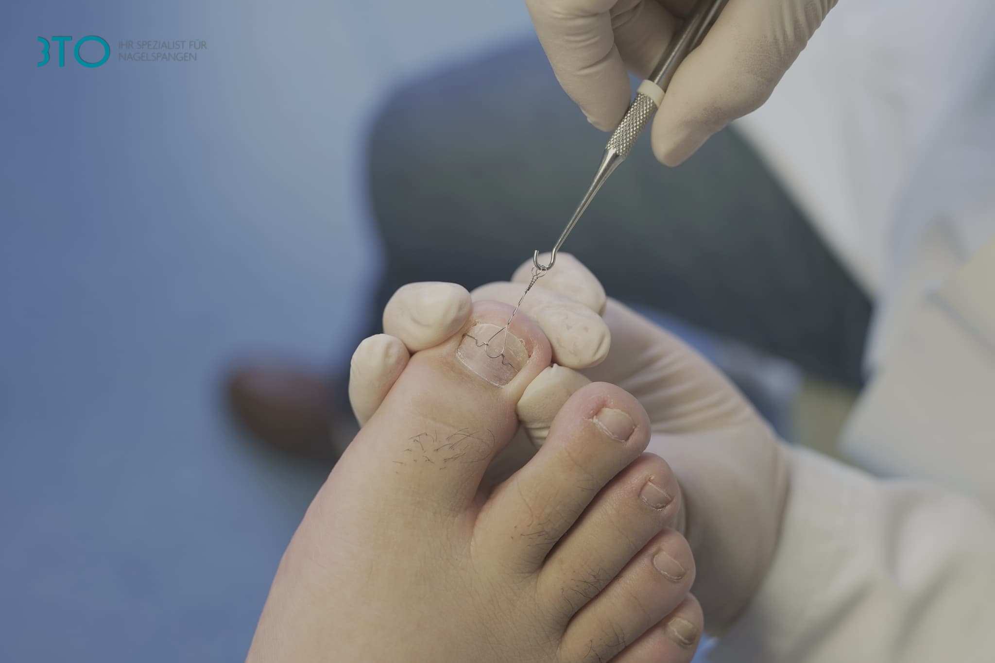 Traitement des ongles incarnés